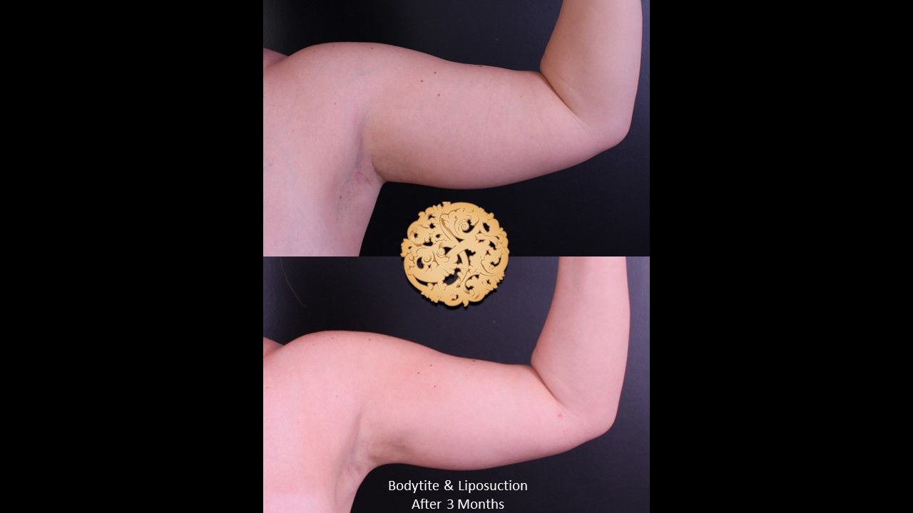 Bodytite Before & After