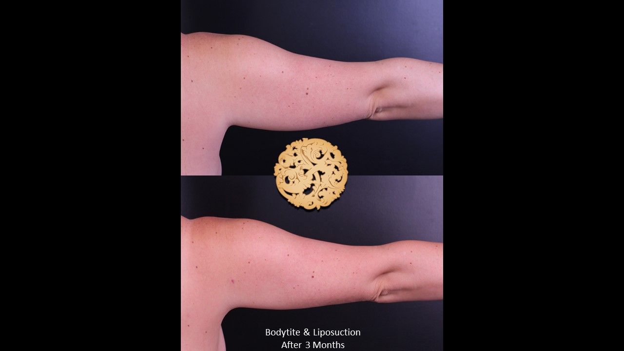 Bodytite Before & After