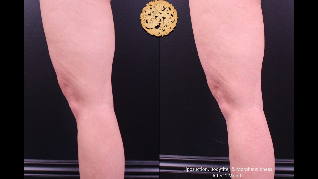 Bodytite Before & After