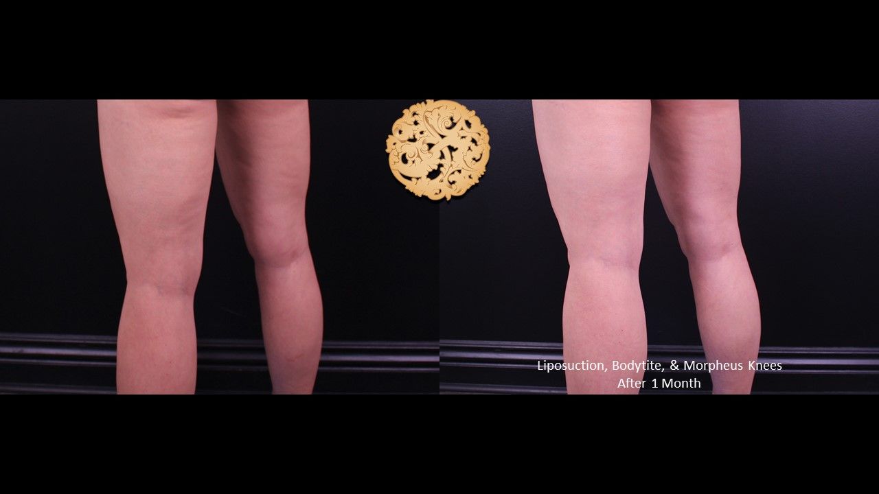 Bodytite Before & After