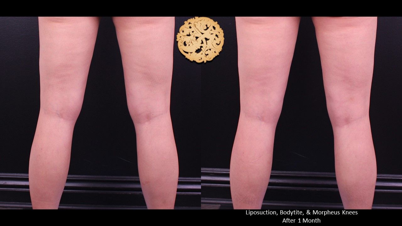 Bodytite Before & After