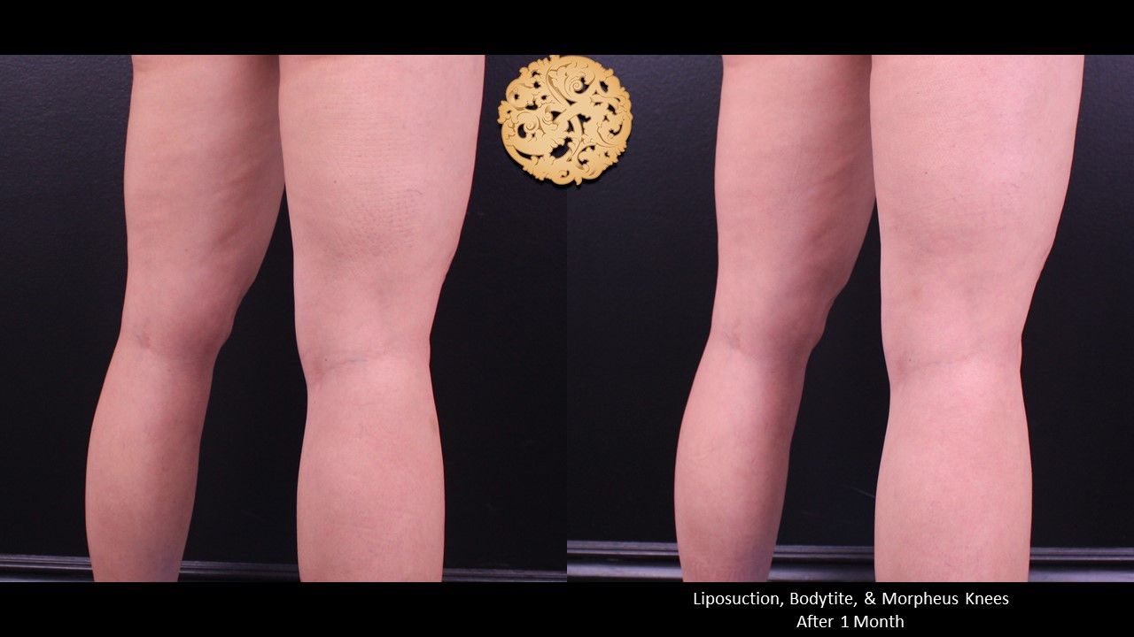 Bodytite Before & After