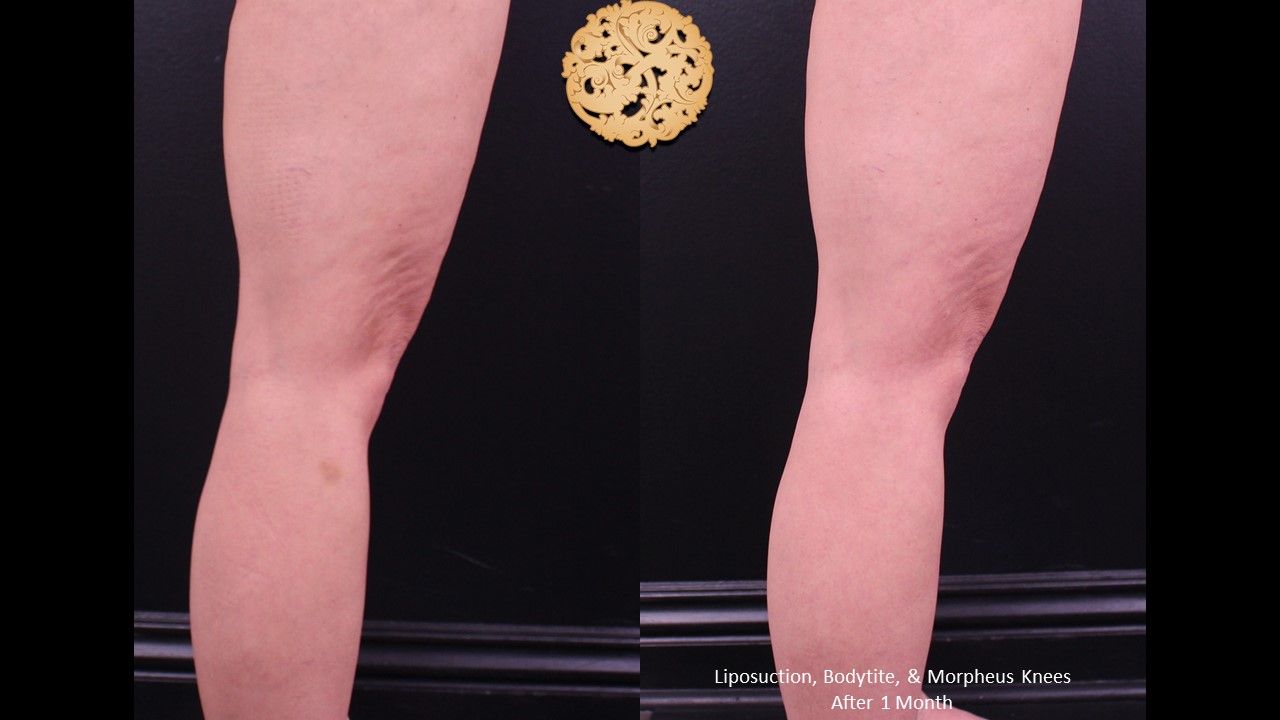 Bodytite Before & After