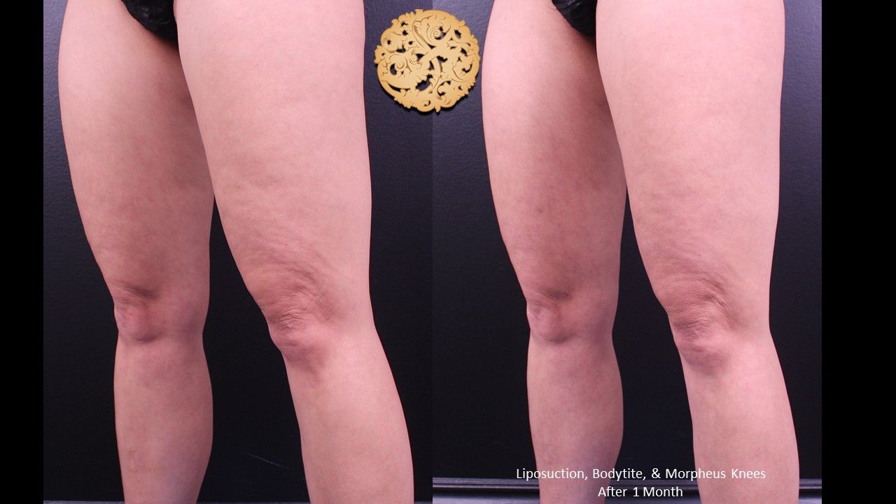 Bodytite Before & After