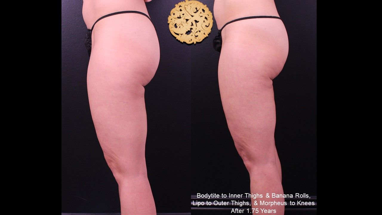 Bodytite Before & After