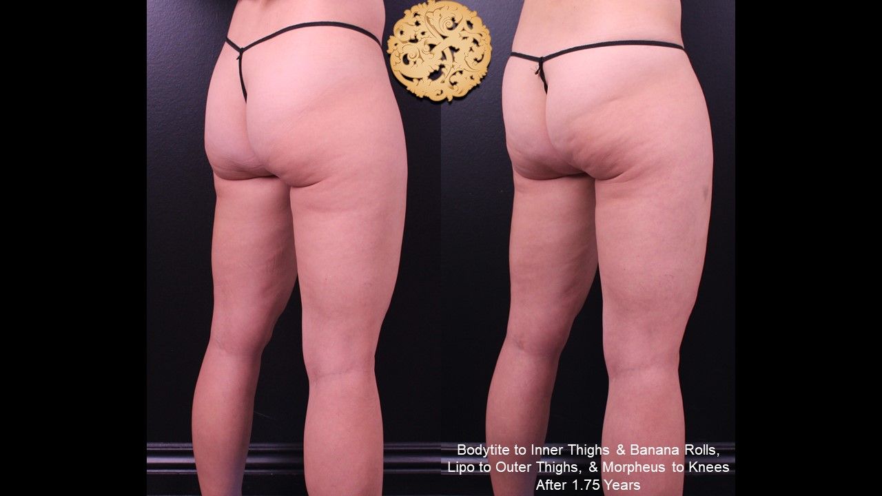 Bodytite Before & After