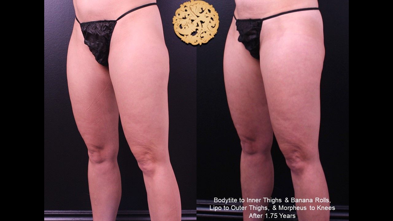 Bodytite Before & After