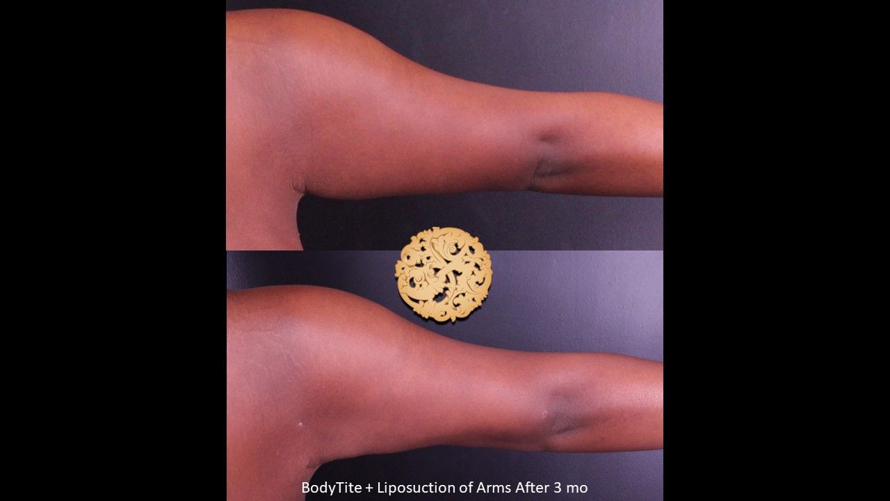 Bodytite Before & After