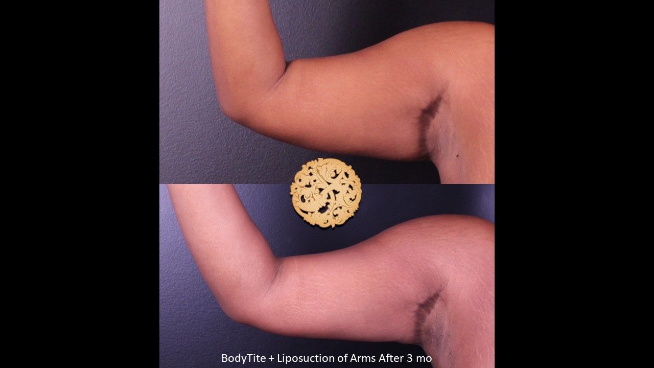 Bodytite Before & After