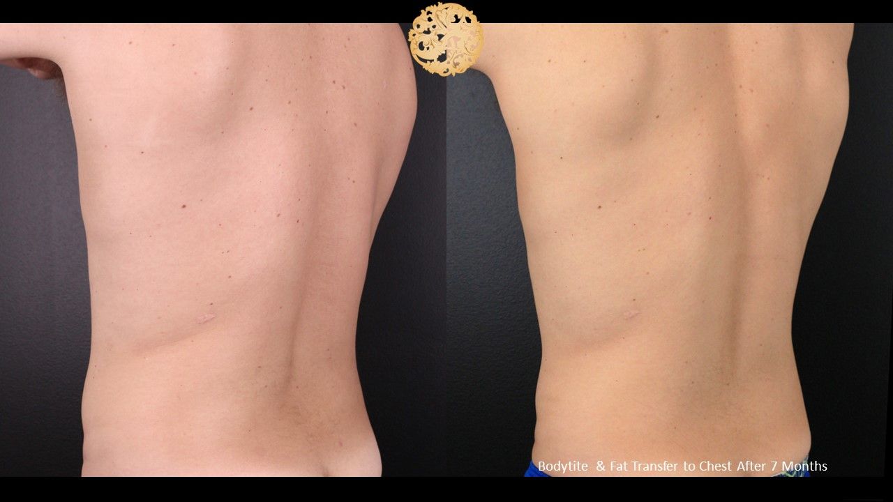 Bodytite Before & After