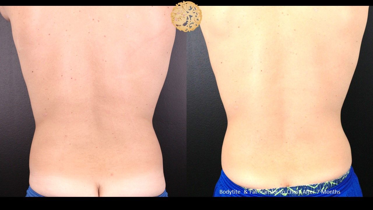 Bodytite Before & After