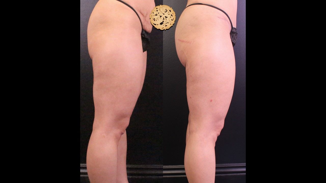 Bodytite Before & After
