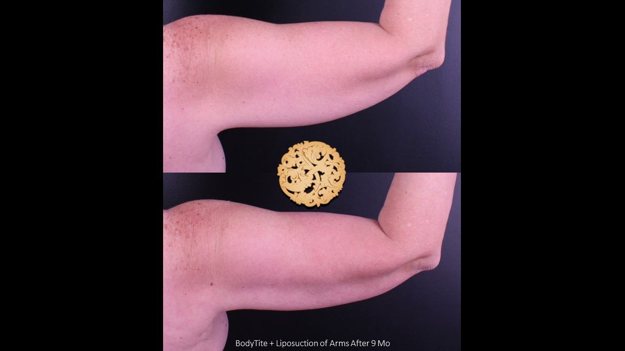 Bodytite Before & After