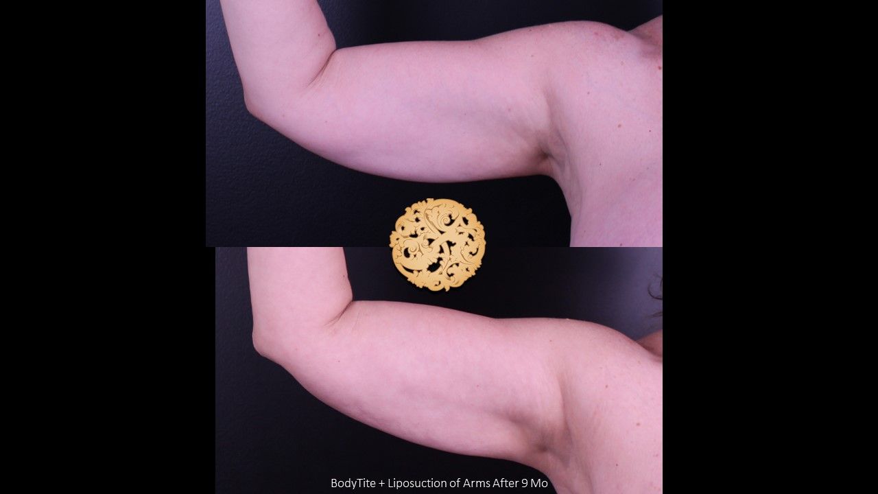 Bodytite Before & After