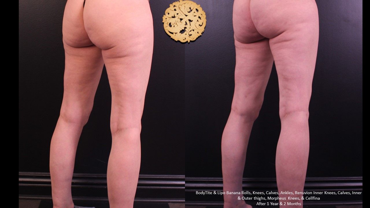 Bodytite Before & After