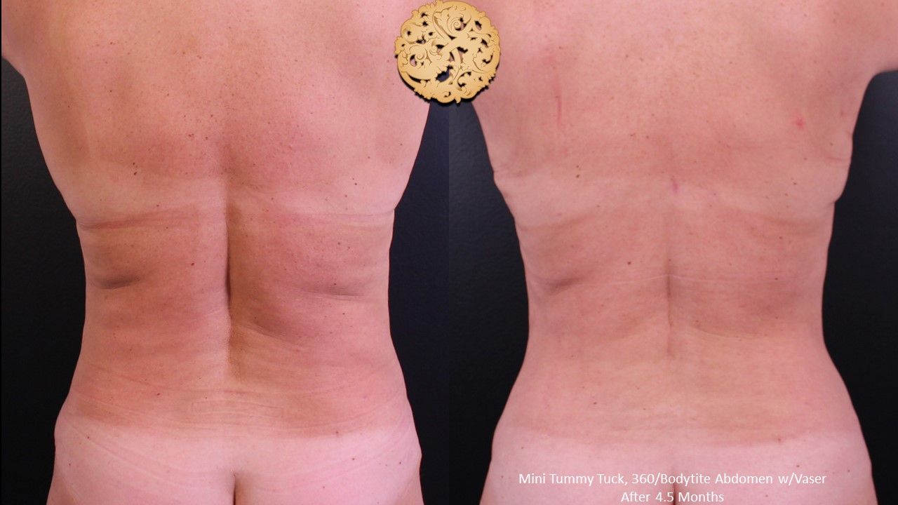 Bodytite Before & After