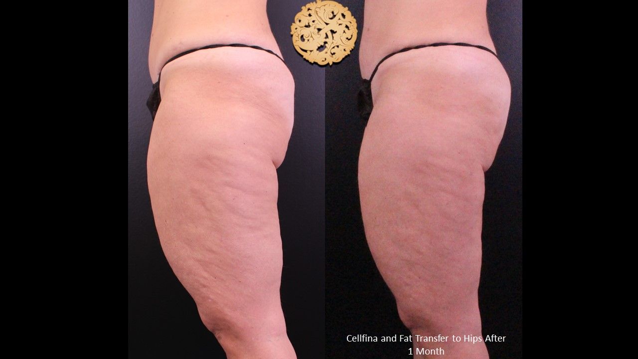 Bodytite Before & After