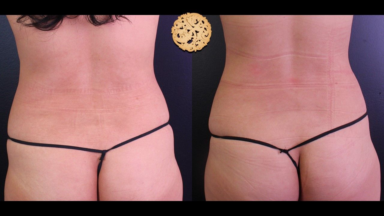 Bodytite Before & After