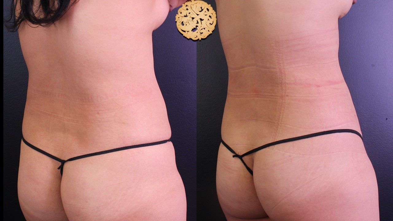 Bodytite Before & After