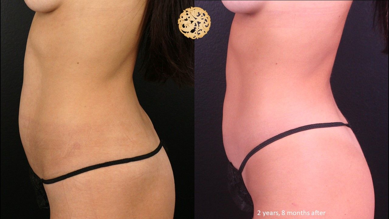 Bodytite Before & After