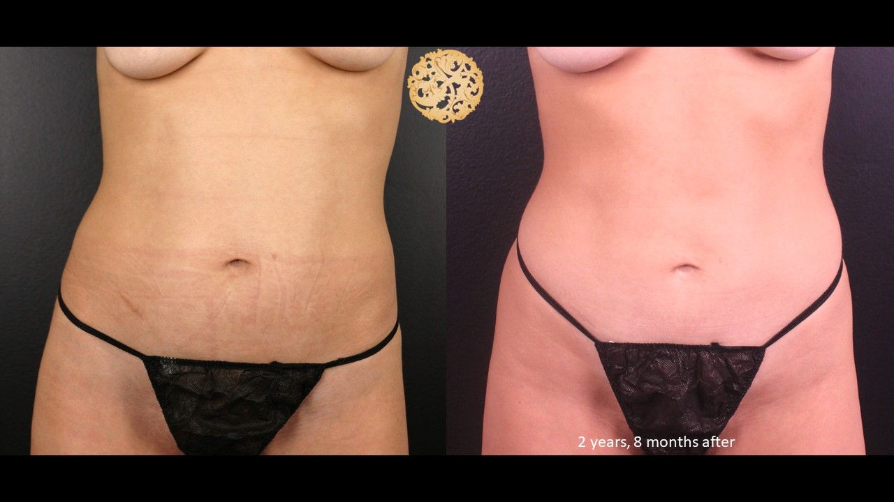 Bodytite Before & After