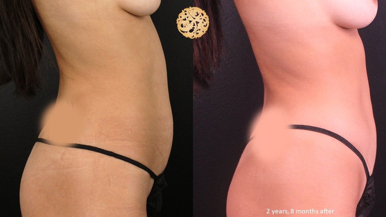 Bodytite Before & After