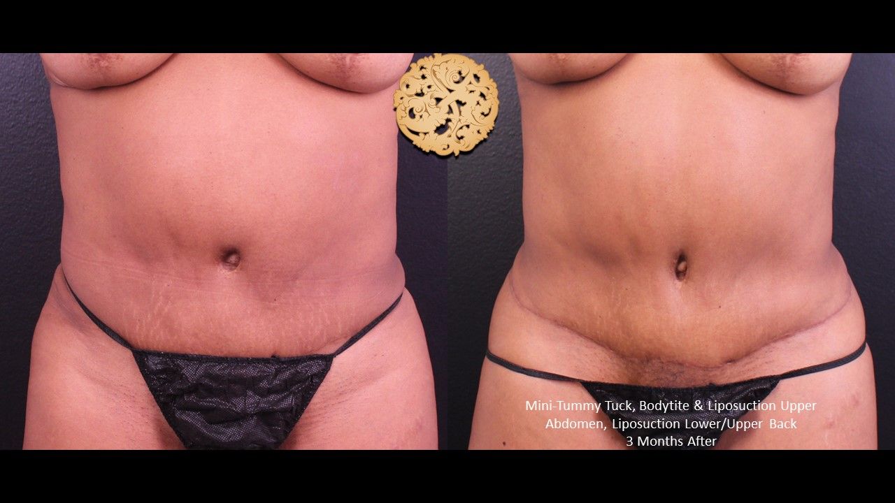 Bodytite Before & After
