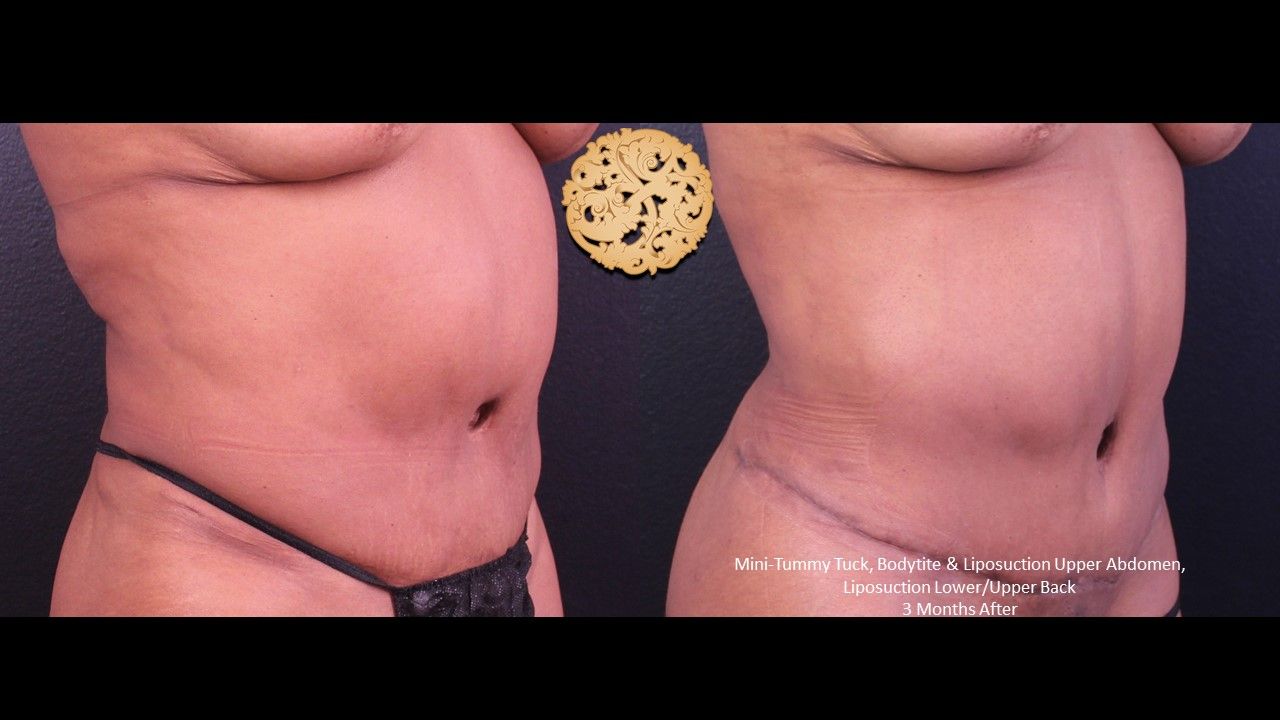 Bodytite Before & After