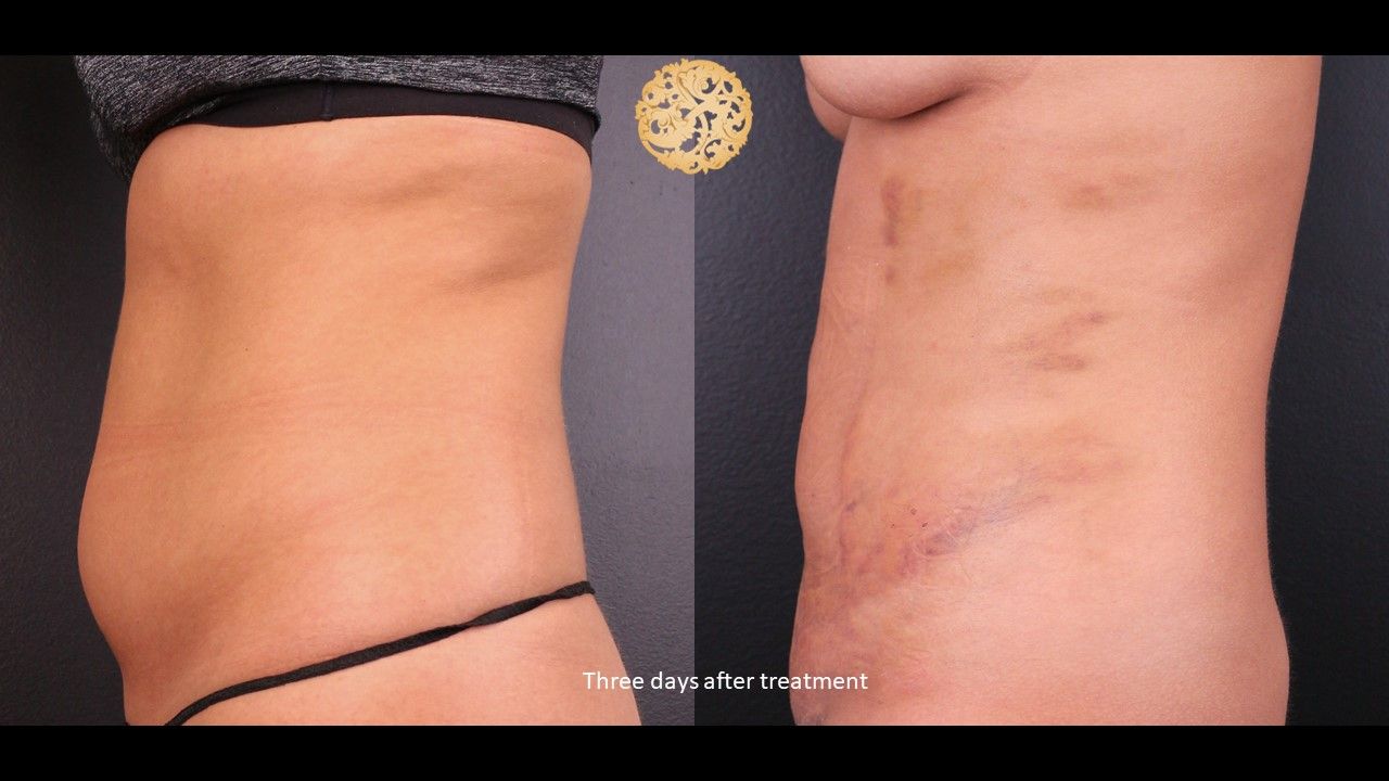 Bodytite Before & After