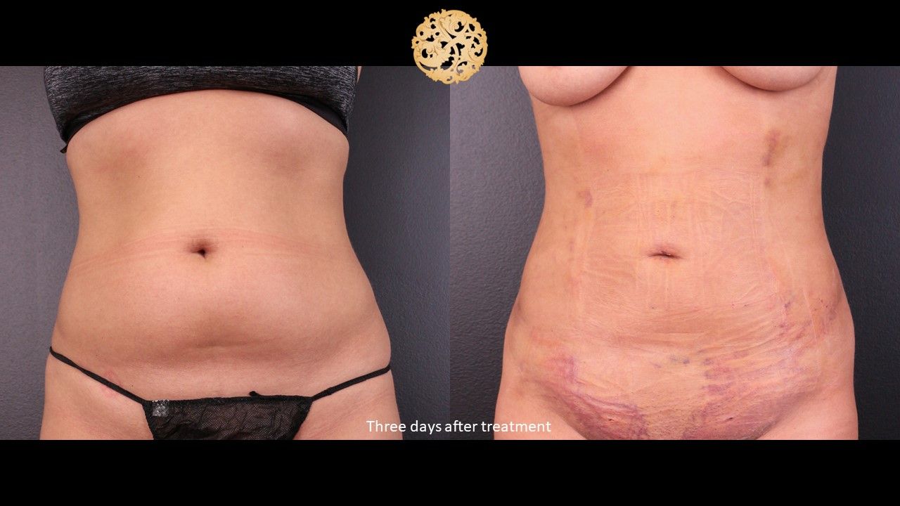 Bodytite Before & After