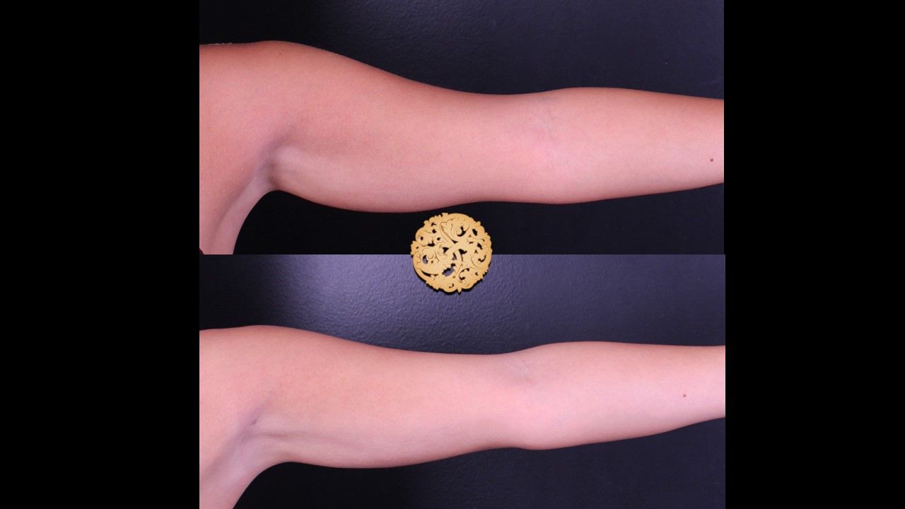 Bodytite Before & After