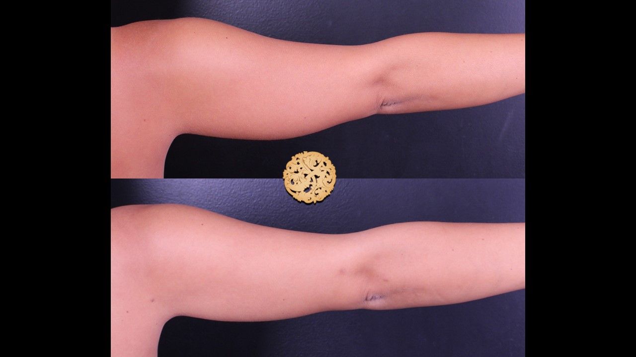 Bodytite Before & After