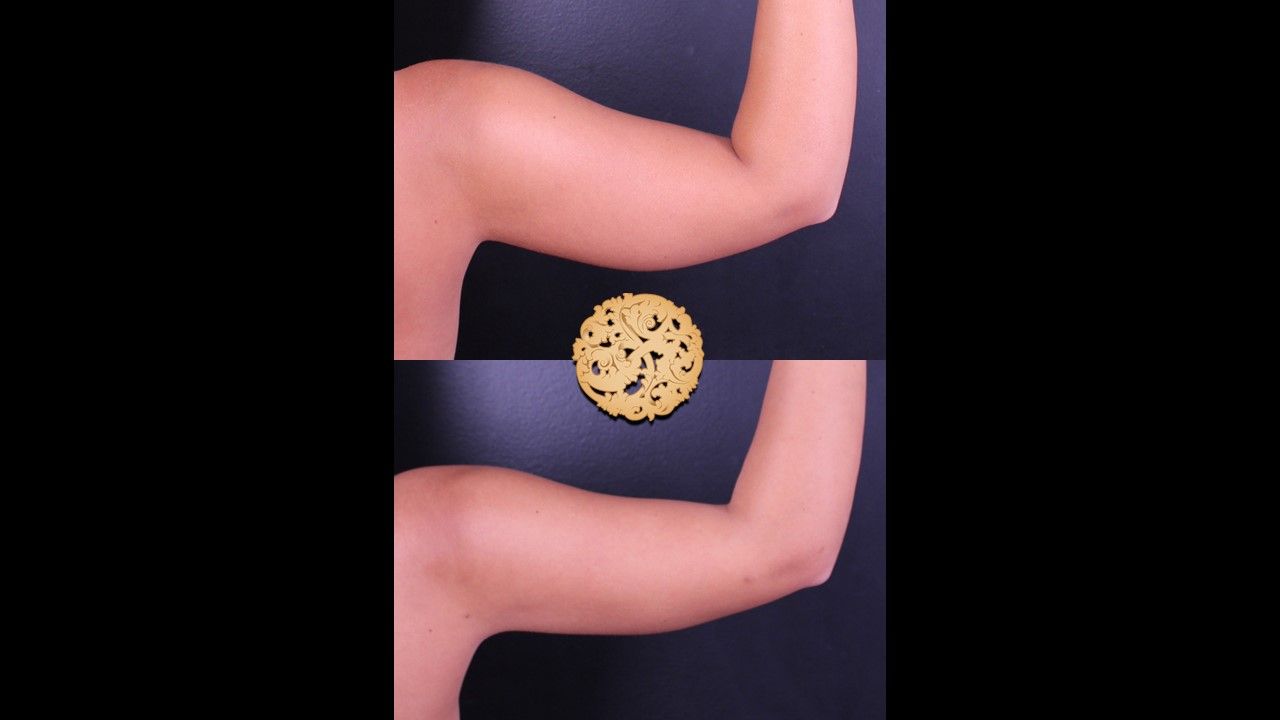 Bodytite Before & After