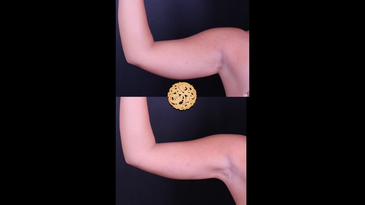 Bodytite Before & After