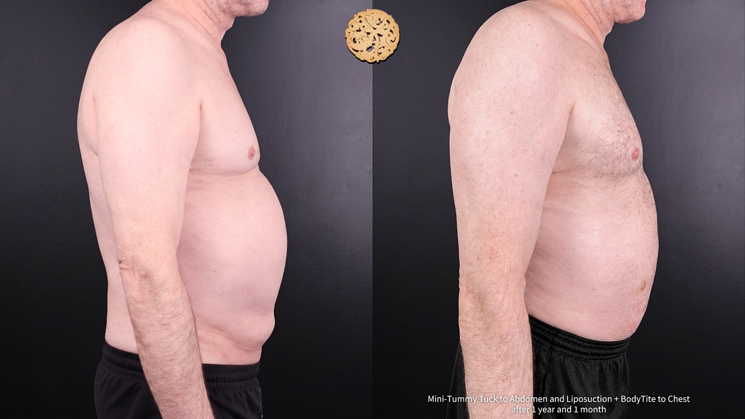 BodyTite Before & After