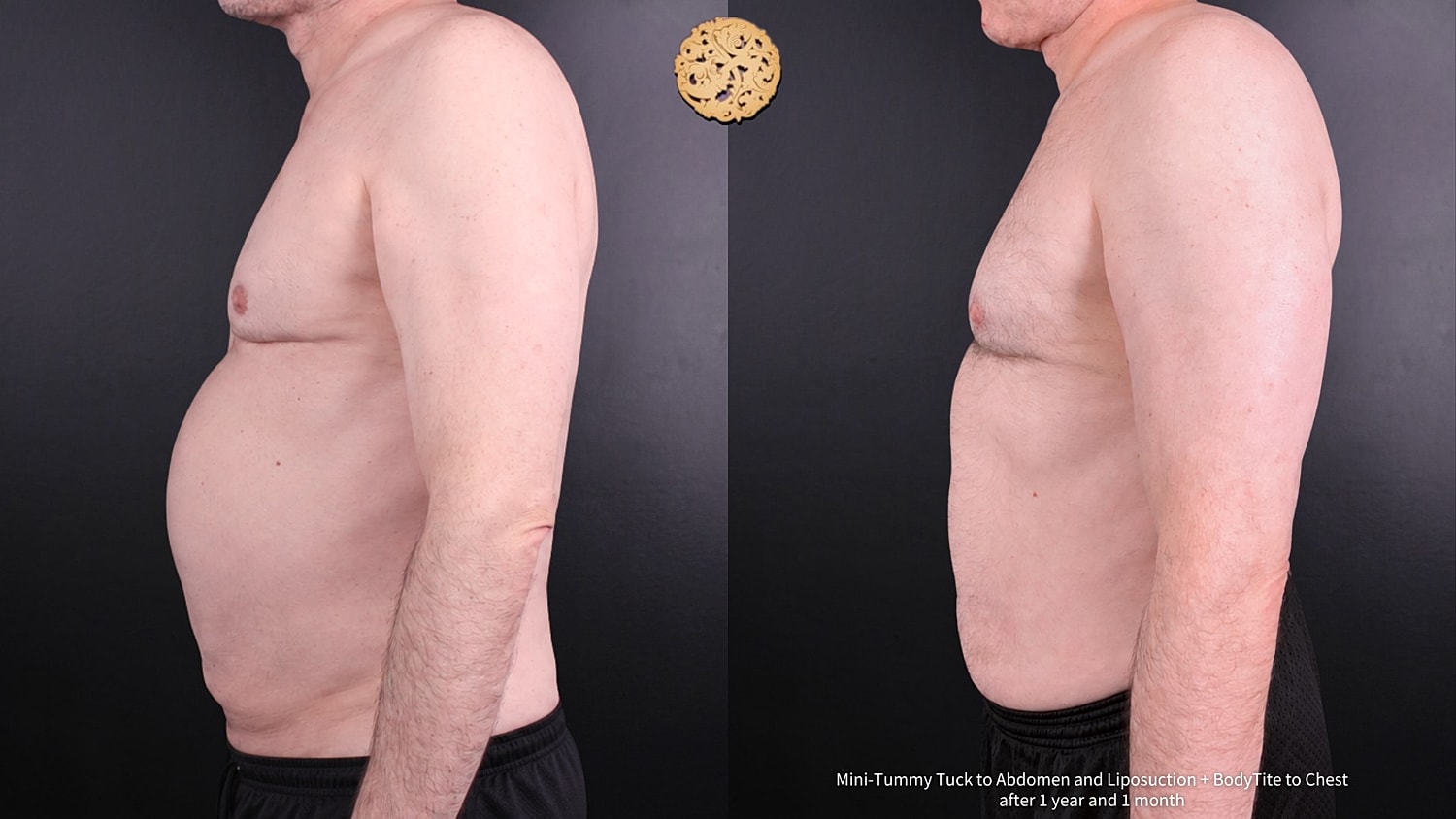 BodyTite Before & After