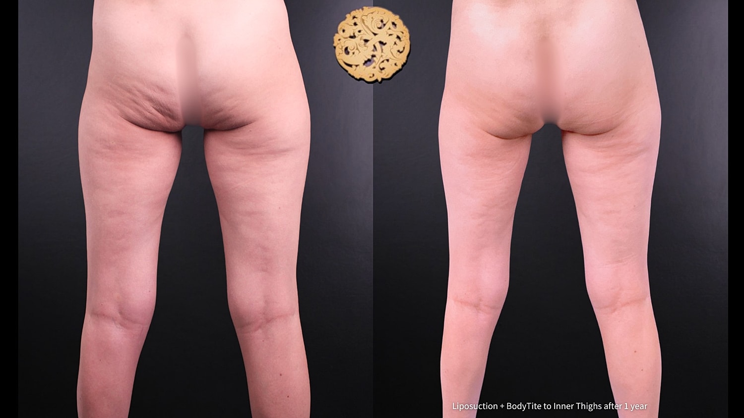 BodyTite Before & After