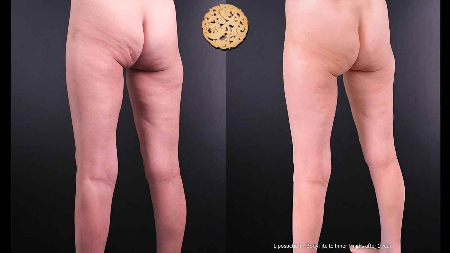 BodyTite Before & After