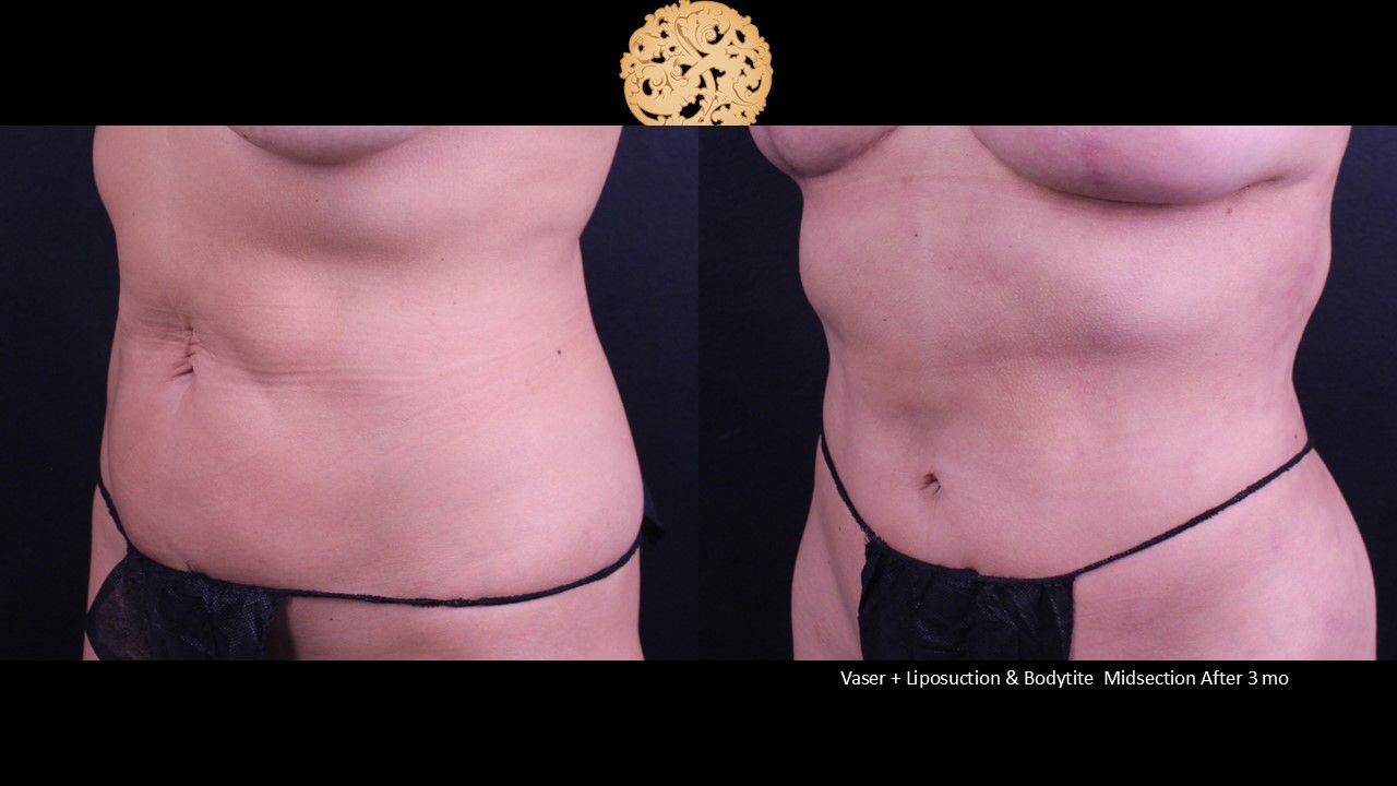 BodyTite Before & After