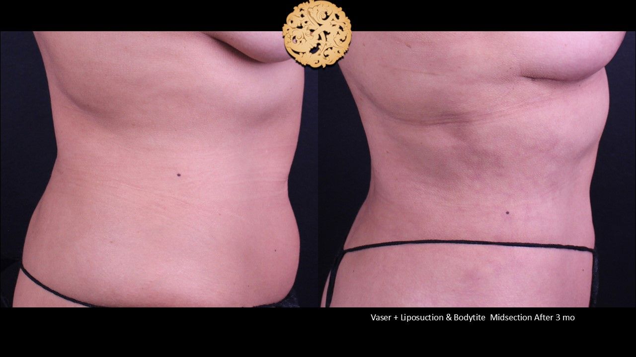 BodyTite Before & After