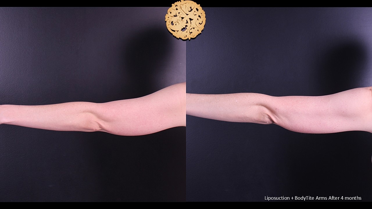 BodyTite Before & After