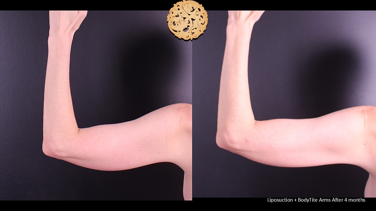 BodyTite Before & After