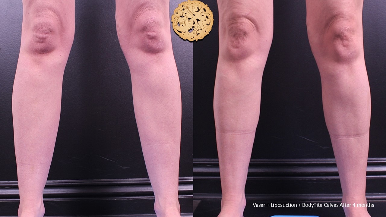 BodyTite Before & After