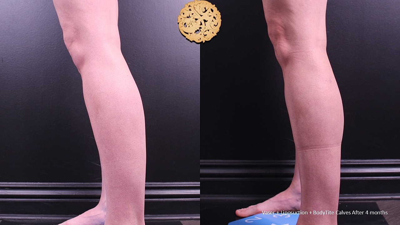 BodyTite Before & After