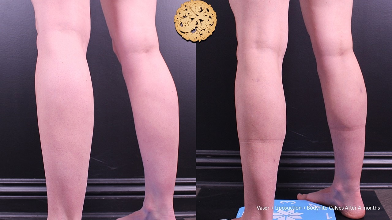 BodyTite Before & After