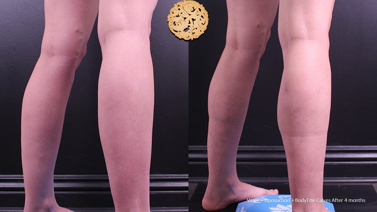 BodyTite Before & After