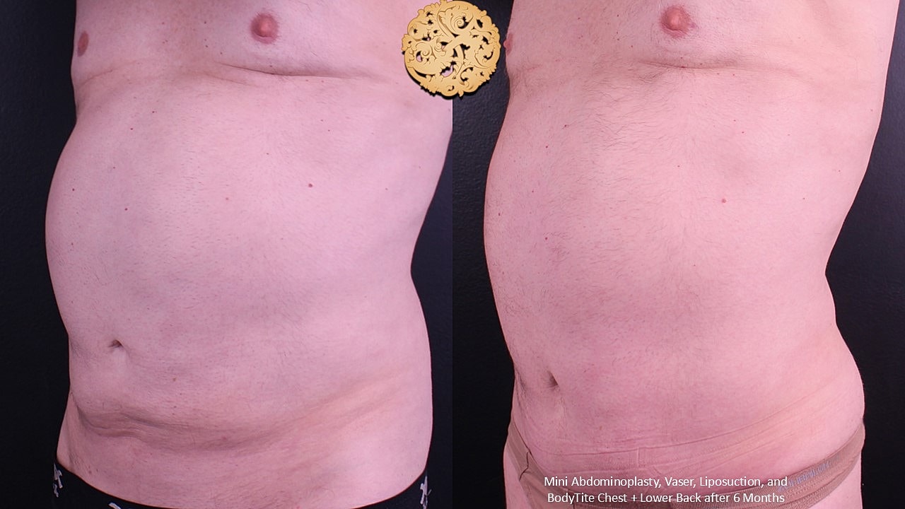 BodyTite Before & After