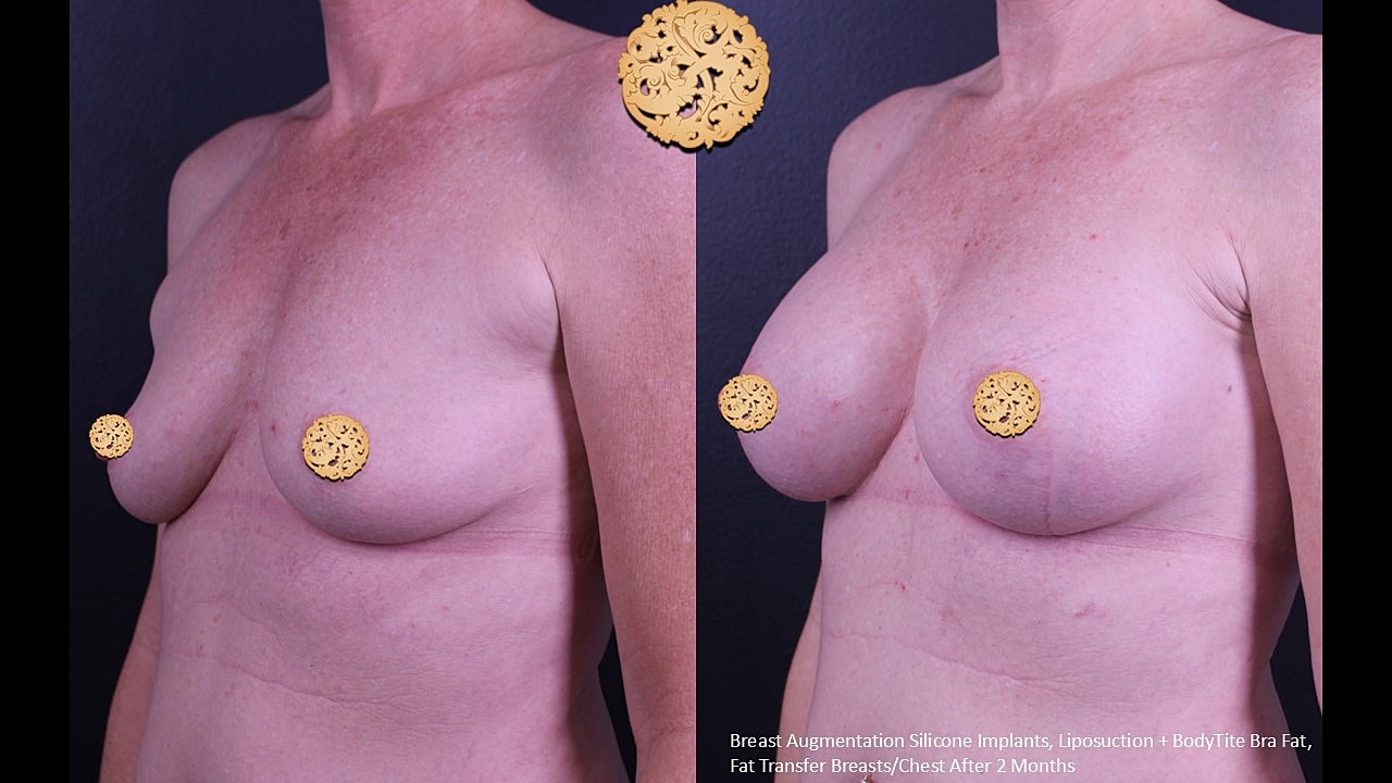 Before and after breast augmentation results.