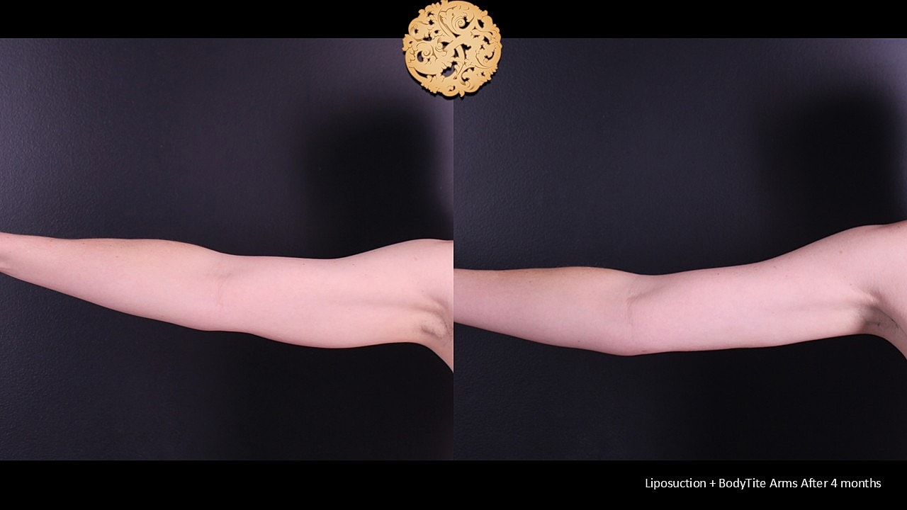 BodyTite Before & After