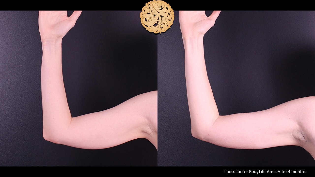 BodyTite Before & After